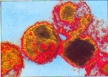 VIH: VIRUS DE LA INMUNODEFICIENCIA HUMANA