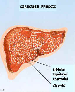 cirrosis hepatica