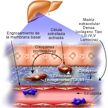 cirrosis hepatica