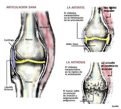 La Artrosis